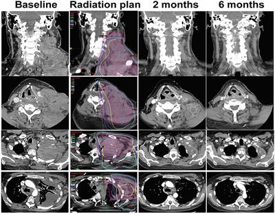 Radiation Therapy Combined With Checkpoint Blockade Immunotherapy for Metastatic Undifferentiated Pleomorphic Sarcoma of the <mark class="highlighted">Maxillary Sinus</mark> With a Complete Response
